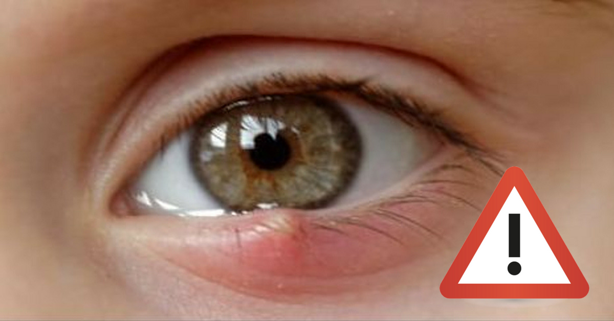 10 skutecznych sposobów na jęczmień. Dzięki nim, zniknie o wiele szybciej!