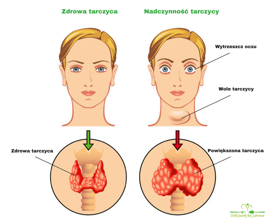 Wiele Polek ignoruje objawy chorej tarczycy. To główna przyczyna otyłości i bezpłodności