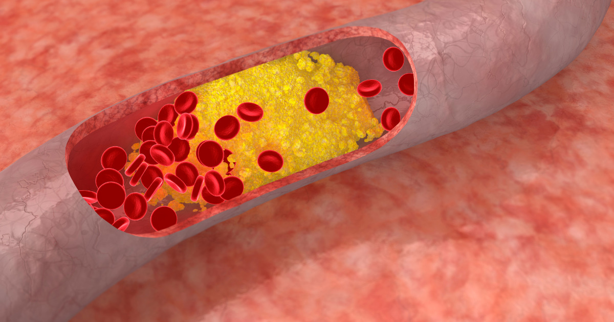 6 produktów, które obniżają wysoki cholesterol. Zmniejsz jego poziom w zaledwie 4 dni!