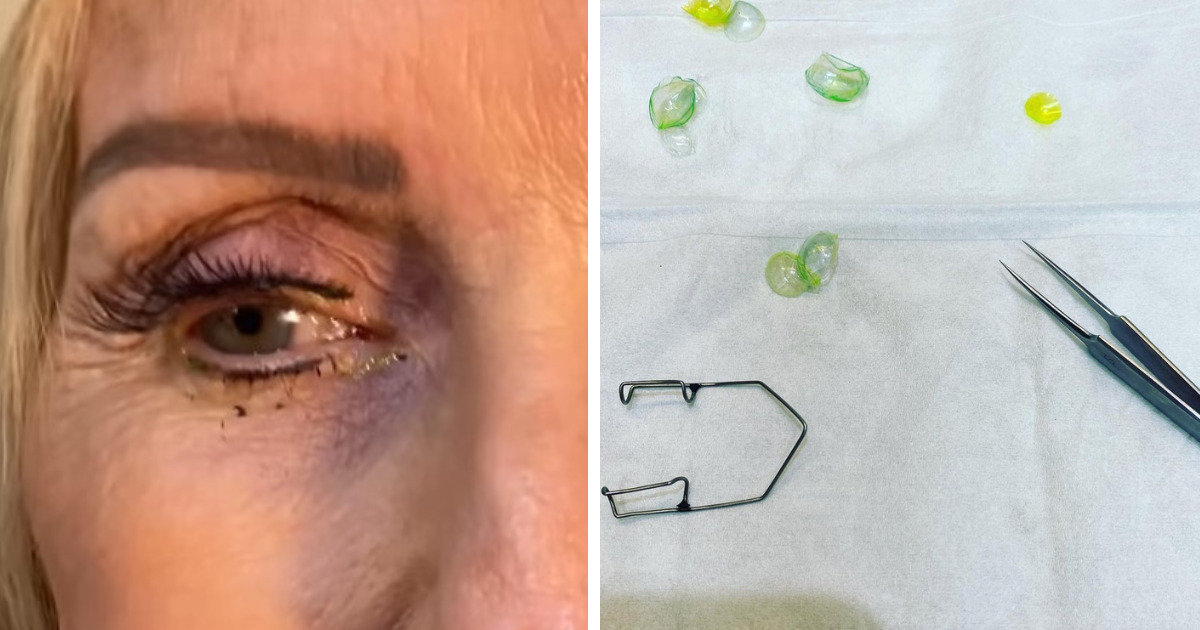 Przyszła do lekarza, skarżąc się na "niewyraźne widzenie". Okulistka zamarła