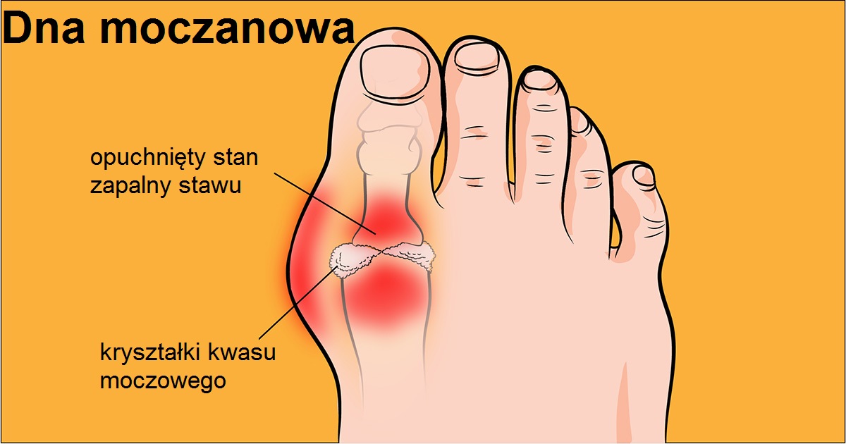 7 naturalnych środków zaradczych, które ukoją ból i przyspieszą leczenie ataków dny moczanowej