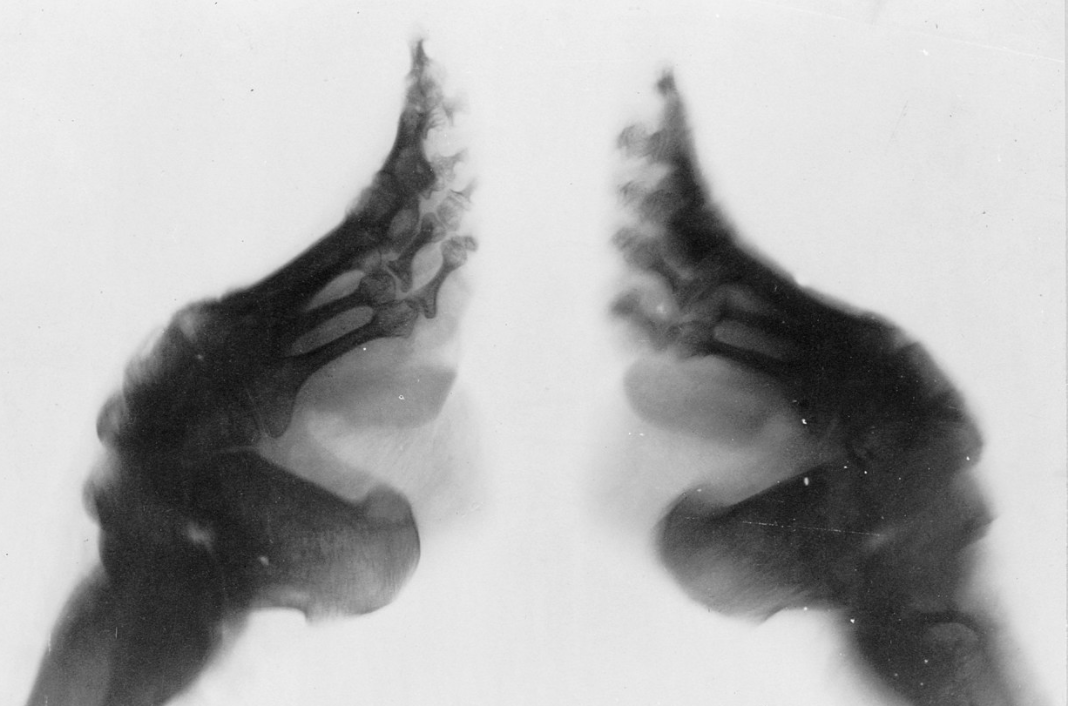 Tak wyglądają zdeformowane stopy Chinek. Trudno uwierzyć, przez co przechodziły te kobiety