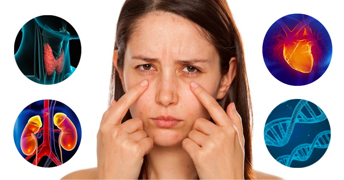 Worki pod oczami – przyczyny mogą Cię zaskoczyć. To nie objaw zmęczenia!