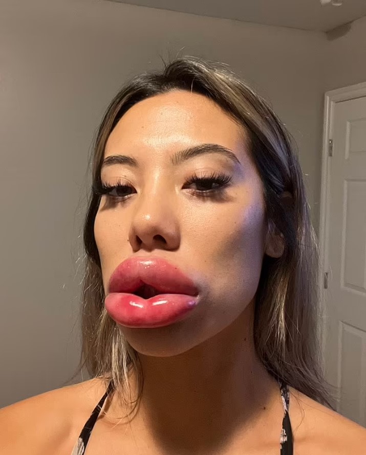 24-latka trafiła do szpitala po zabiegu powiększania ust. "Bałam się, iż odetną mi usta"