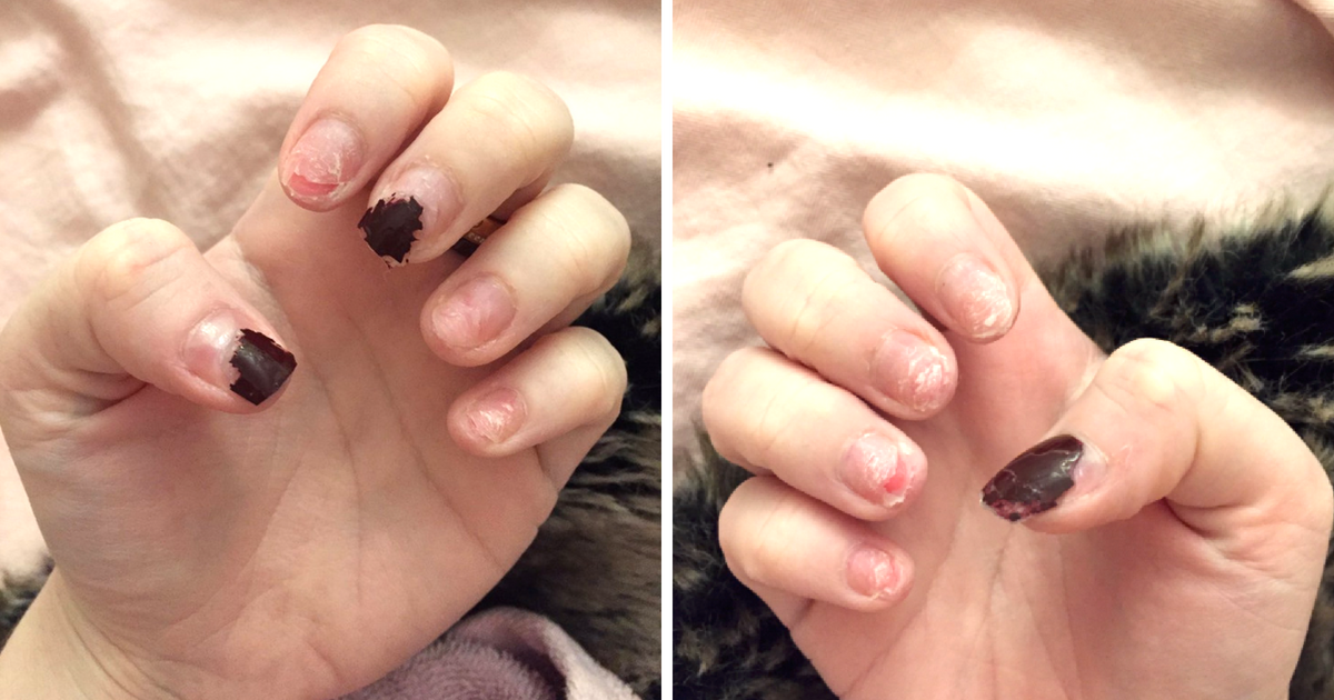 Sepsa pod hybrydą. Kosmetyczki niechętnie o tym mówią!