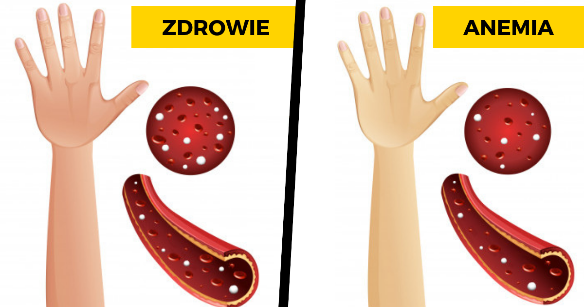 7 subtelnych objawów niedokrwistości z których nie zdajesz sobie sprawy. Możesz jej zapobiec