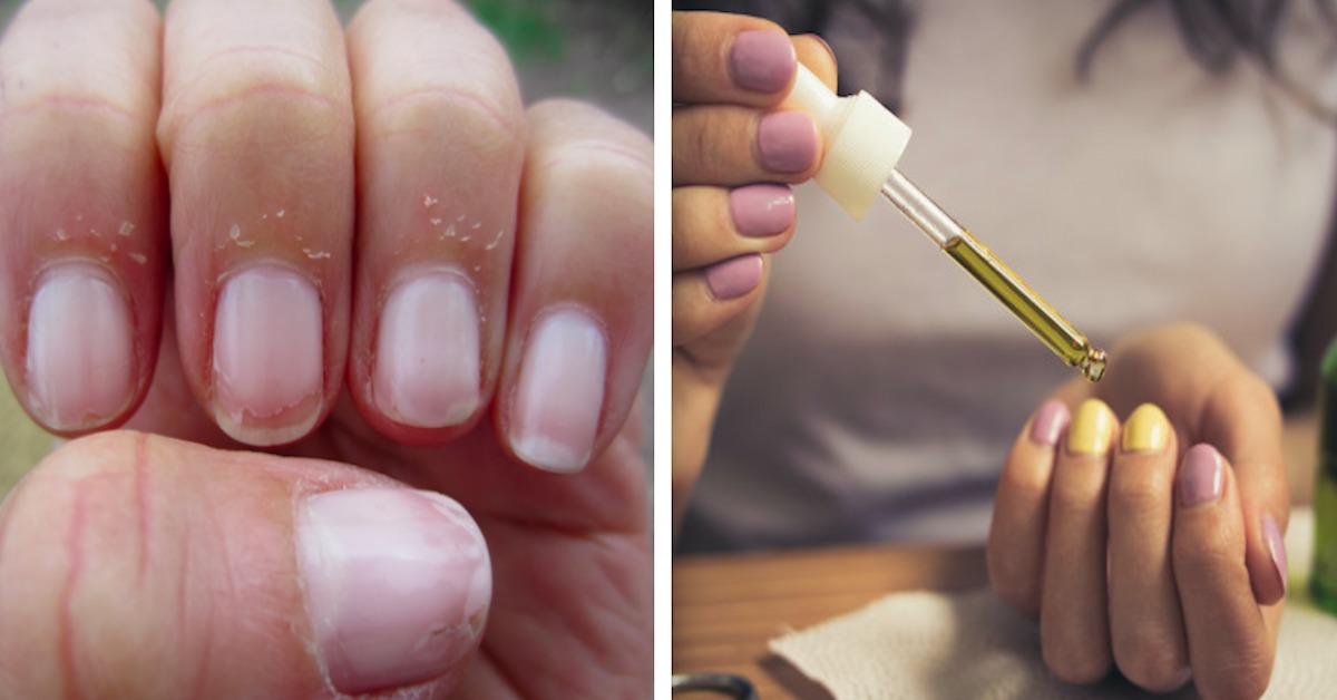 Suche skórki wokół paznokci – przyczyny i domowe sposoby na pozbycie się ich