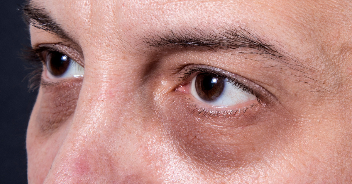 Oto, co dzieje się w organizmie, jeżeli pod Twoimi oczami pojawiają się cienie