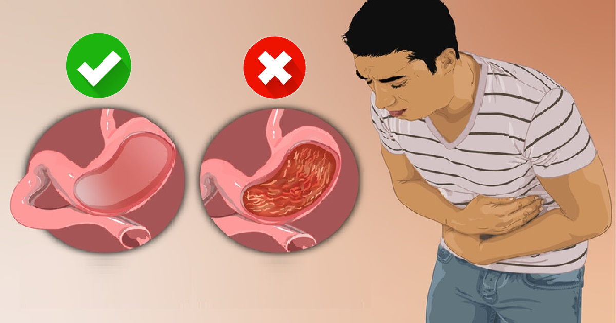 10 objawów zapalenia błony śluzowej żołądka. Cierpi na nie miliony Polaków