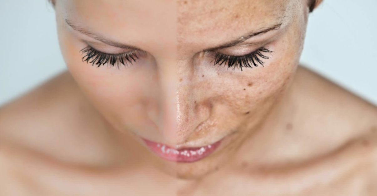 Pozbądź się wągrów i innych zanieczyszczeń skóry w całkowicie naturalny i tani sposób