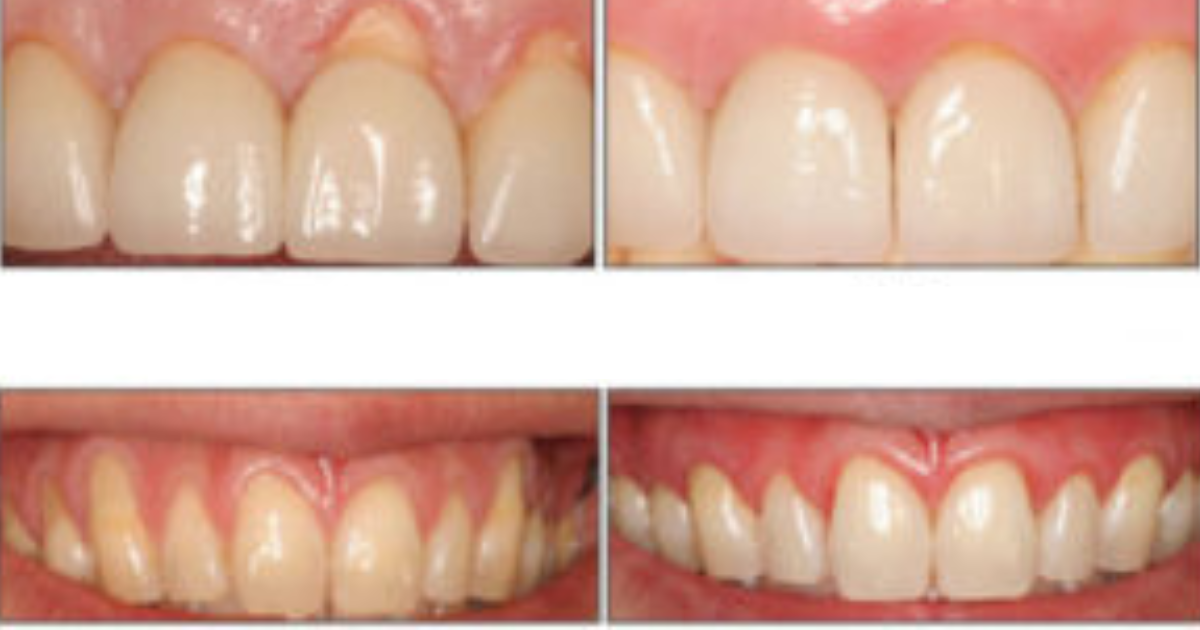 Jeśli masz problemy z dziąsłami, spróbuj choć jednej z tych 8 sztuczek. Nie czekaj tylko działaj